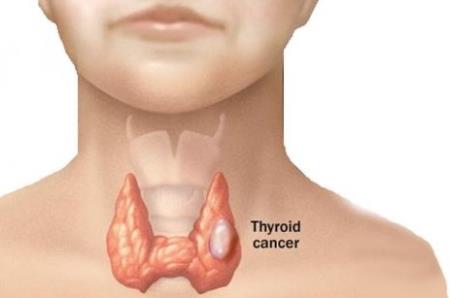 16 tuổi ung thư tuyến giáp - Bác sĩ ung thư nói gì?