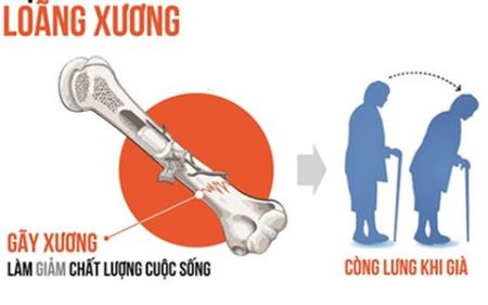 Loãng xương và những hậu quả kéo theo