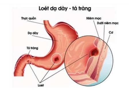 Người mẫu Ninh Dương Lan Ngọc bị cảnh báo nguy cơ mắc ung thư