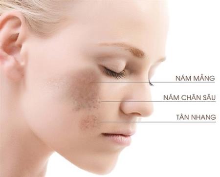 Nám da do di truyền, trị thế nào cho trúng và hiệu quả