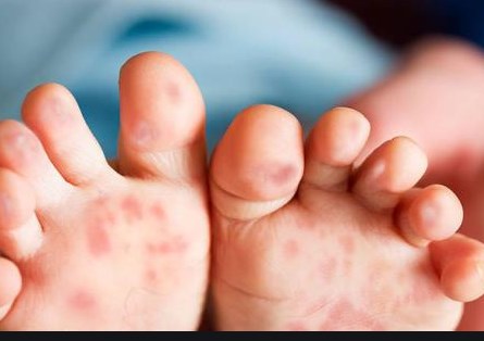 Chăm sóc trẻ mắc bệnh tay chân miệng