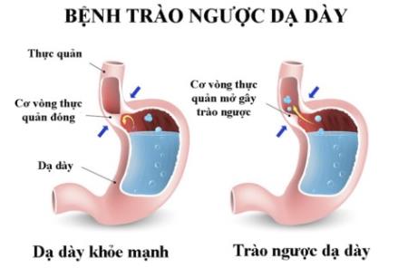 Bài thuốc trị bệnh trào ngược dạ dày thực quản