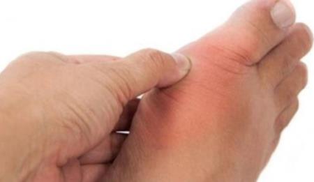 9 nguy cơ dễ làm khởi phát bệnh gút