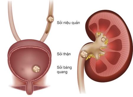Bác sĩ mách bạn cách đẩy lùi bệnh sỏi thận, không cần phẫu thuật