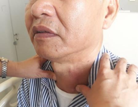 Nuốt nước bọt có triệu chứng này, cần cảnh giác với khối u vùng cổ