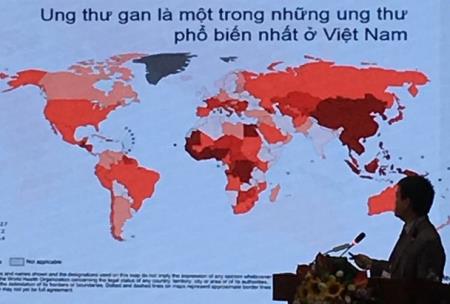 Ung thư gan tăng chóng mặt ở Việt Nam: Đây là 5 dấu hiệu cần nhớ
