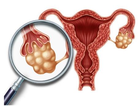 Dấu hiệu sớm của ung thư buồng trứng