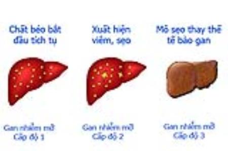 Bé 10 tuổi đã gan nhiễm mỡ: Những người sau phải hết sức chú ý