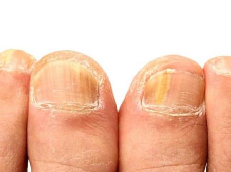 Móng tay vàng là dấu hiệu cảnh báo những vấn đề sức khỏe nghiêm trọng này