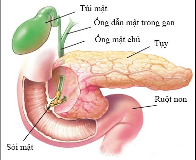 Biểu hiện của sỏi mật và các chữa trị