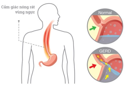 Thay đổi thói quen sinh hoạt để đẩy lùi bệnh trào ngược dạ dày