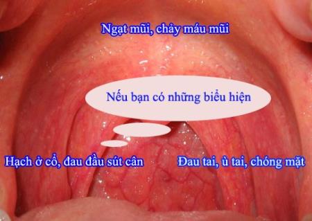3 dấu hiệu điển hình nhận biết ung thư vòm họng sớm
