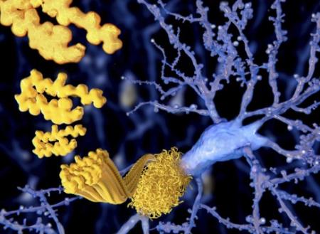 Một loại thuốc của Nga khiến bệnh nhân Alzheimer phục hồi trí nhớ