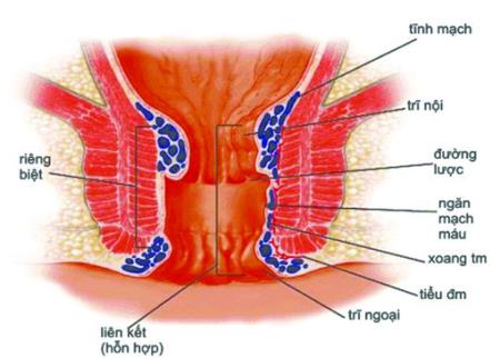 Top những loại thuốc điều trị bệnh trĩ tốt nhất hiện nay