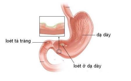 Top 5 thuốc điều trị viêm loét dạ dày tá tràng