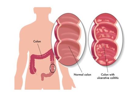 Cơ chế ngăn ngừa bệnh Crohn được công bố