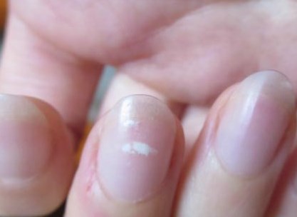 Đốm trắng trên móng tay do nguyên nhân gì, cách khắc phục