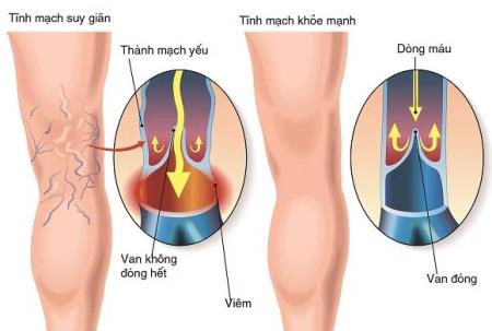 Vì sao nổi gân xanh trên cơ thể