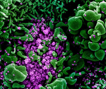 Hình ảnh nCoV bám đặc quanh tế bào người