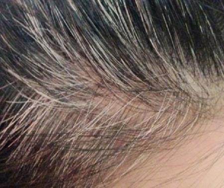 Các nhà khoa học tìm ra cơ chế stress gây ra tóc bạc như thế nào