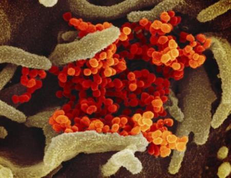 Diễn biến của người bệnh mắc Covi-19 : SARS-CoV-2 "tinh vi" ra sao khi làm "nổ tung" tế bào phổi để phát tán virus?