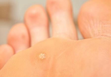 Dấu hiệu của bàn chân cần đi khám ngay