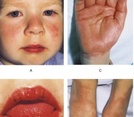 Ý: Các bác sĩ tìm thấy mối liên hệ giữa Covid-19 và chứng rối loạn viêm