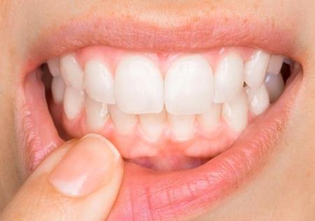 Vi khuẩn Pg gây ung thư, tiểu đường và Alzheimer