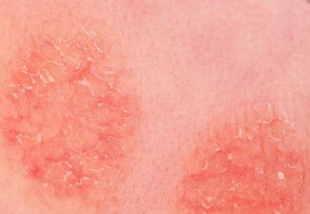 Cách tiếp cận mới để điều trị bệnh chàm