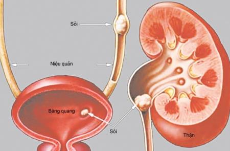 Những thực phẩm cần tránh khi đang bị sỏi thận