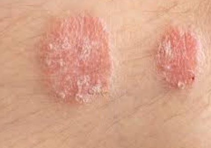 Nguồn gốc phát triển của bệnh chàm và bệnh vẩy nến được phát hiện