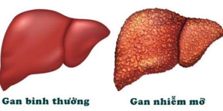 Bài thuốc tự nhiên giúp trị gan nhiễm mỡ