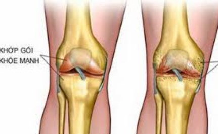 Phương pháp mới ngăn chặn quá trình thoái hóa sụn khớp gối