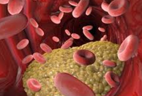 Rối loạn mỡ máu và biến chứng