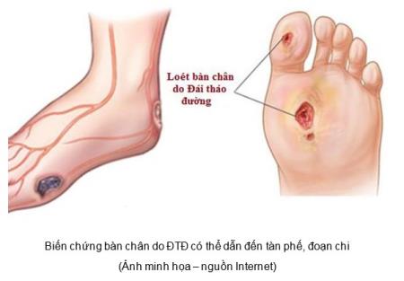 Chăm sóc bàn chân đái tháo đường sao cho đúng cách
