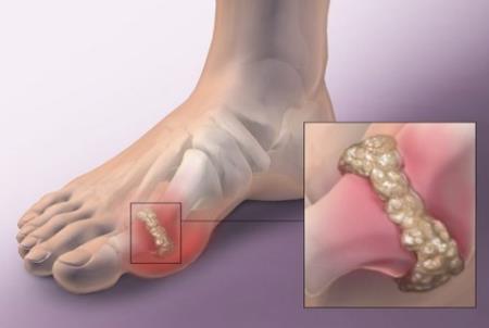 Bệnh gút và cách phòng ngừa, điều trị hiệu quả