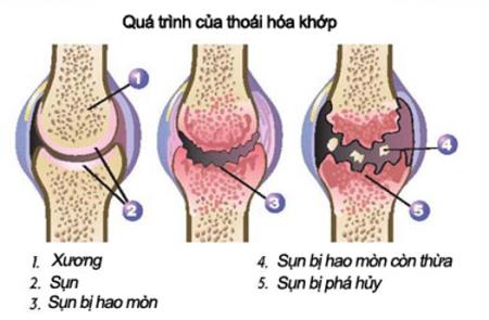 Thoái hóa khớp - Phát hiện sớm để phòng ngừa và bảo vệ khớp