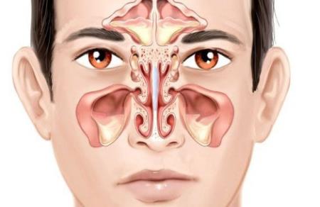 Viêm xoang - căn bệnh phổ biến gây nhiều phiền toái