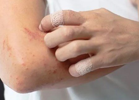 Các nhà nghiên cứu sử dụng liệu pháp vi khuẩn để cải thiện các triệu chứng của bệnh viêm da dị ứng