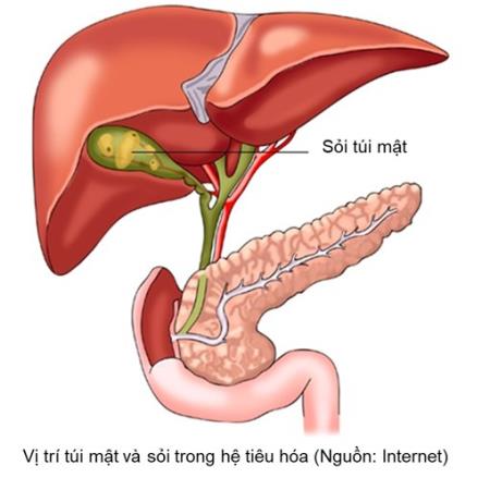 80% Bệnh nhân bị sỏi túi mật nhưng không có triệu chứng