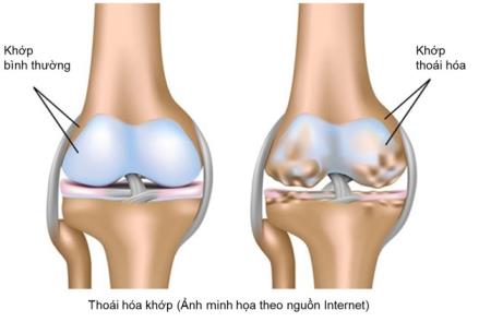 BỆNH NHÂN THOÁI HÓA KHỚP CẦN LƯU Ý GÌ KHI DÙNG THUỐC