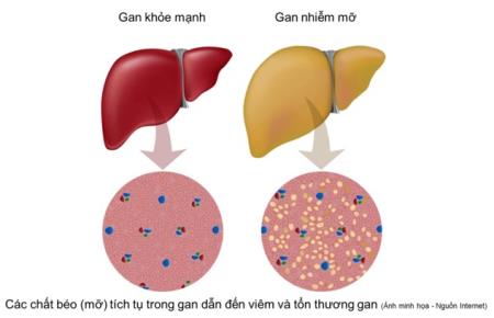 CÓ ĐẾN 90% NGƯỜI NGHIỆN BIA RƯỢU MẮC GAN NHIỄM MỠ