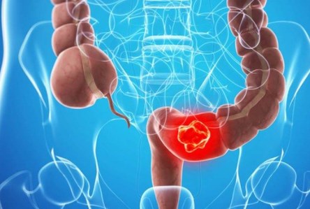 Nếu không muốn mắc ung thư đại trực tràng trước năm 40 tuổi, hãy giảm uống nước ngọt có đường