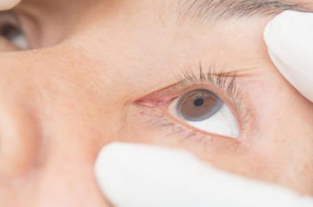 FDA chấp thuận thuốc Verkazia