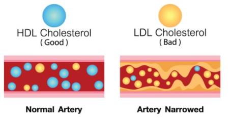 Thuốc Leqvio làm giảm cholesterol xấu (LDL-C)