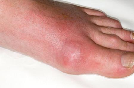 Thuốc MAGRAX-F Etoricoxib 120mg trong giảm đau cơn gút cấp