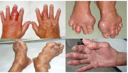 Thuốc hạ acid uric máu – Dự phòng cơn gout cấp