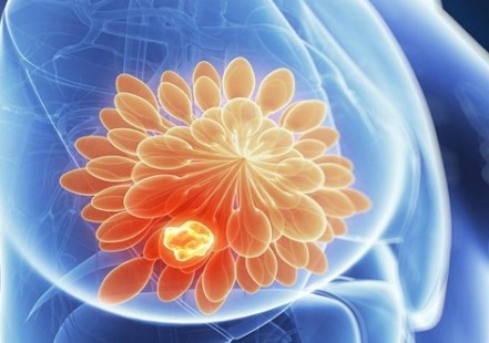 Tại sao ung thư do đột biến BRCA tái phát
