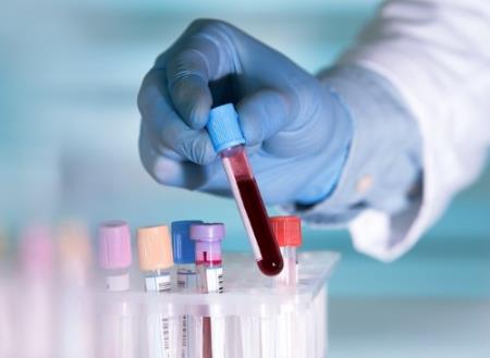 Xét nghiệm máu AI mới phát hiện ung thư gan