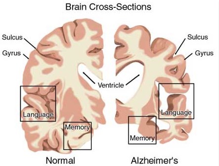 Khám phá có thể giải thích tại sao phụ nữ dễ mắc bệnh Alzheimer hơn